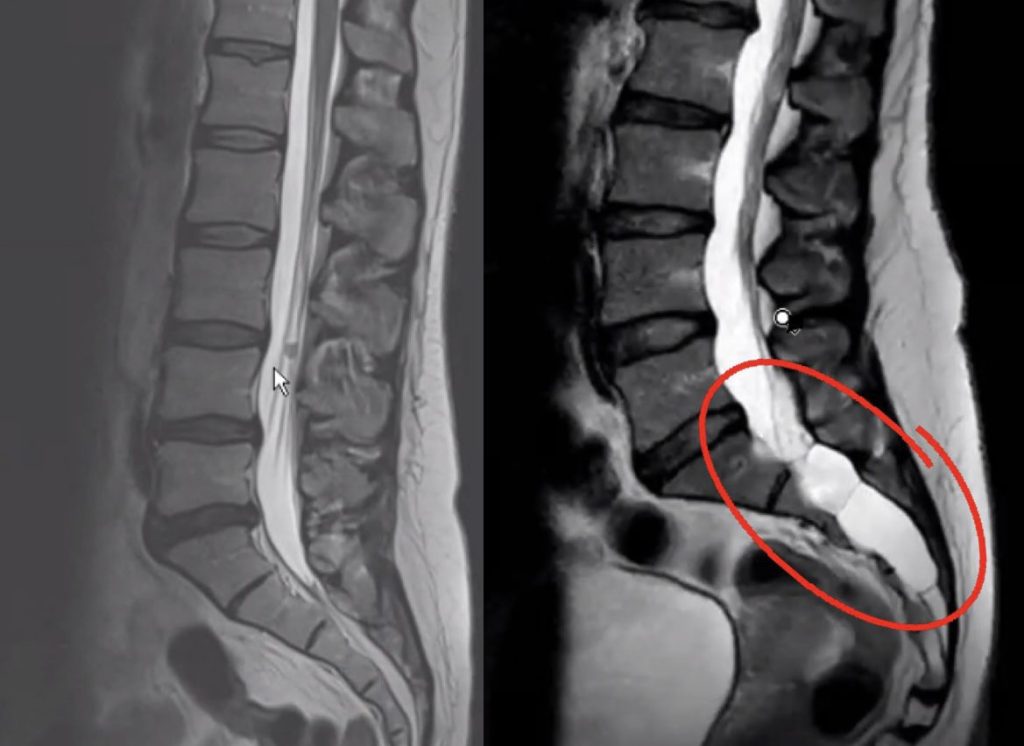 Claire's cyst compared to a healthy spine